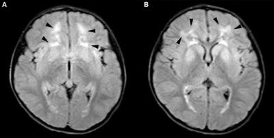 Case report: Alexander's disease with “head drop” as the main symptom and literature review